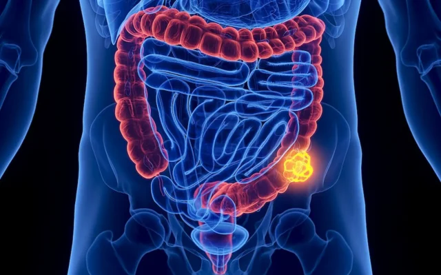 Estudo projeta aumento de mortes e de perda de produtividade por câncer de intestino